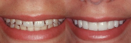 Photo credit: Dr. Alper, DMD, Cosmetic Dentist / Foter / CC BY