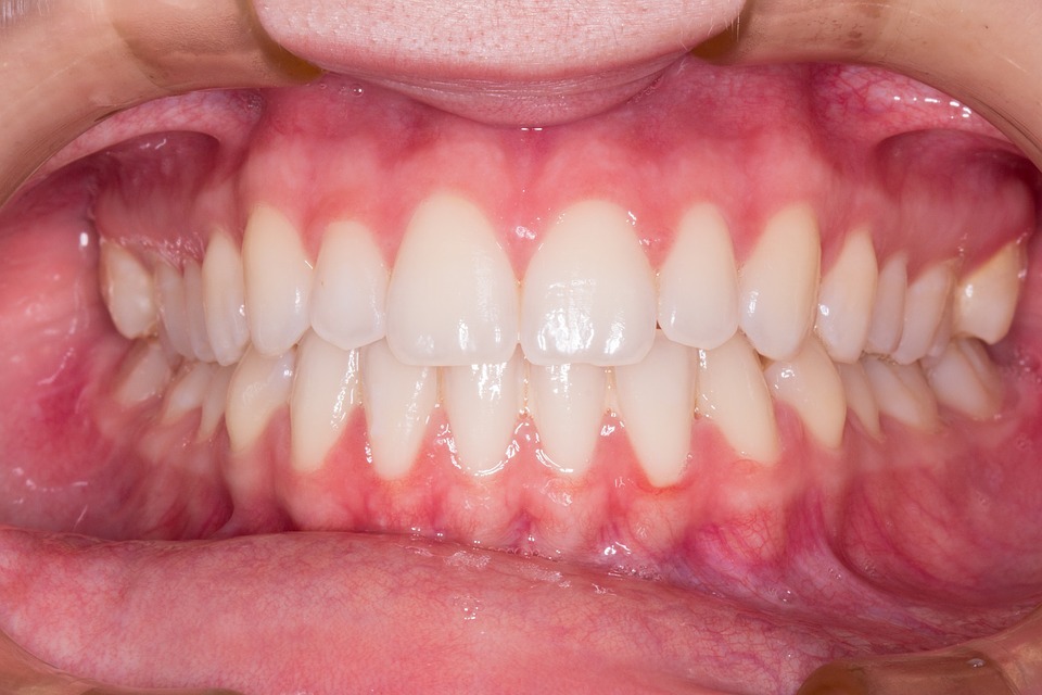 braces